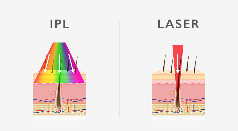 So sánh công nghệ triệt lông IPL và Laser